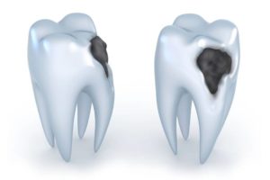 Dentista avaliando cárie profunda em consulta odontológica