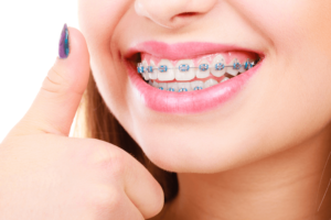 Paciente com aparelho fixo ortodôntico sorrindo