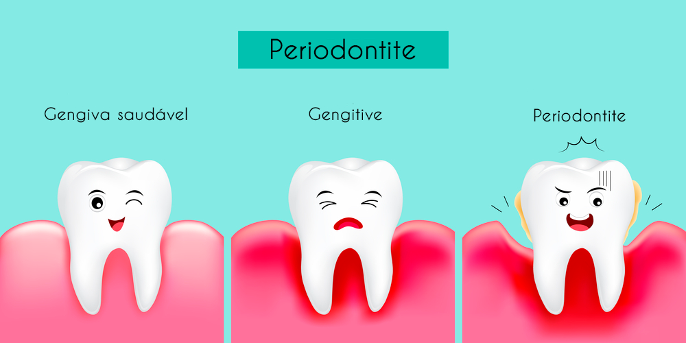Comparação entre gengiva saudável, gengivite e periodontite
