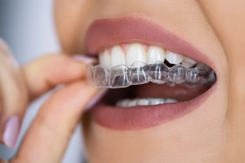 Alinhadores invisíveis sendo colocados em dentes perfeitamente alinhados
