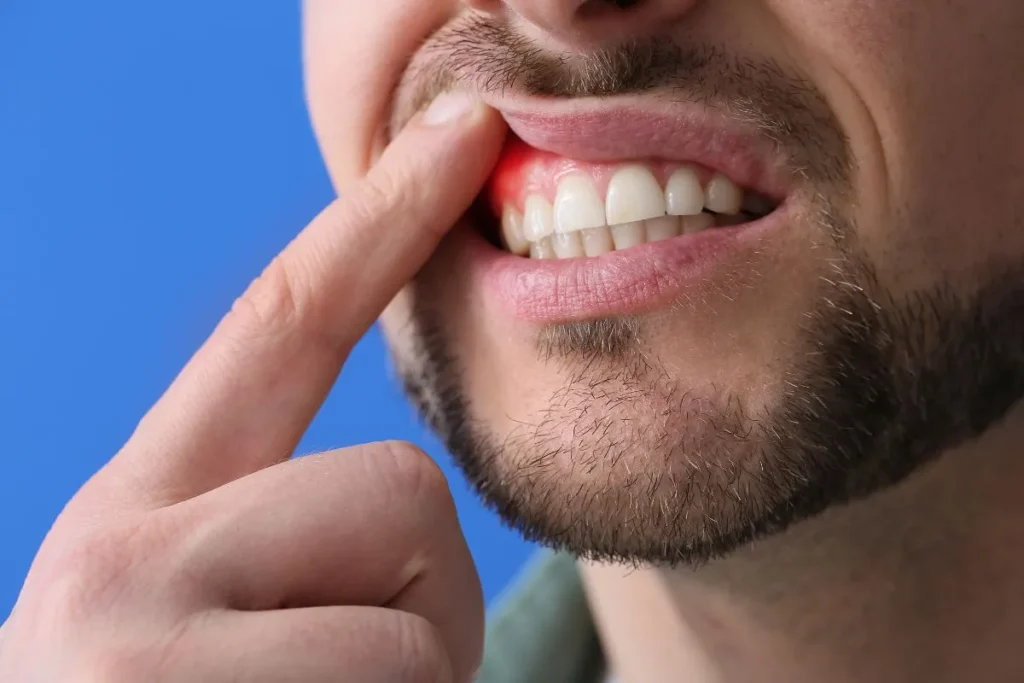 Imagem ilustrativa mostrando a diferença entre gengivite x periodontite, destacando inflamação gengival e perda óssea.