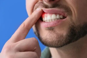 Imagem ilustrativa mostrando a diferença entre gengivite x periodontite, destacando inflamação gengival e perda óssea.